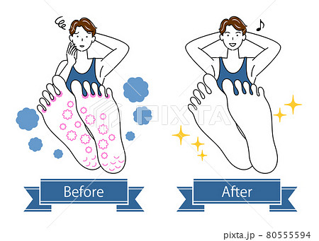 スキンケア 水虫 足裏のお肌トラブルのビフォーアフター 可愛い男性のイラスト シンプル ベクター 80555594