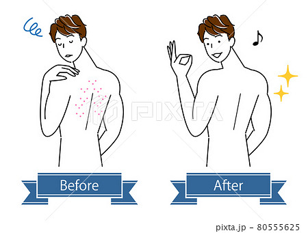 スキンケア 背中の肌荒れのビフォーアフター 可愛い男性のイラスト シンプル ベクター 80555625