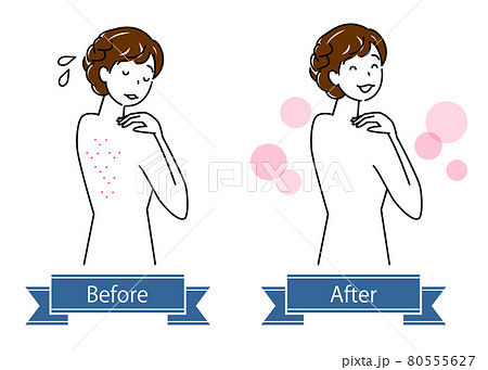 スキンケア 背中の肌荒れのビフォーアフター 可愛い女性のイラスト シンプル ベクターのイラスト素材