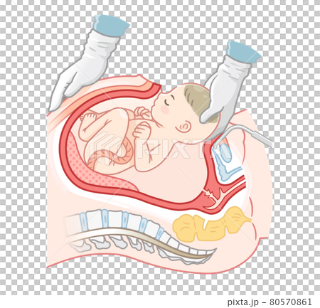 剖腹產嬰兒的插圖 80570861