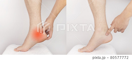 Before and after. On the left, a man holds on to a sore heel that hurts. On the right, the man pain disappeared, and the doctors cured it. Heel spur, muscle strain, tendon injury or microcracks 80577772