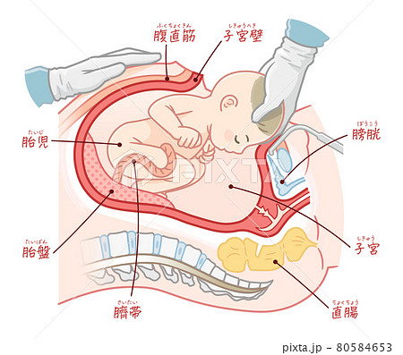 帝王切開で生まれる赤ちゃんのイラスト テキスト付き のイラスト素材