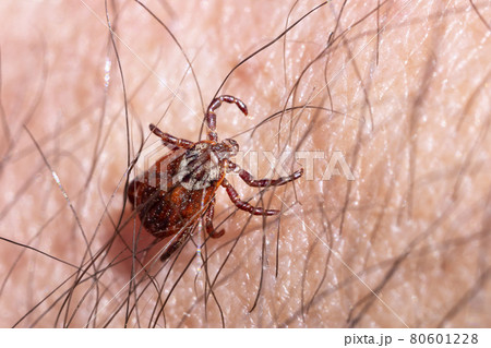 Blood-sucking mite on a human skin macro 80601228