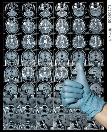 MRI brain scan or magnetic resonance image results, thumbs up 80630175