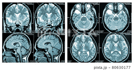 MRI Scan of a human brain showing all main multiple sclerosis MRI Scan of a human brain showing all main multiple sclerosis 80630177