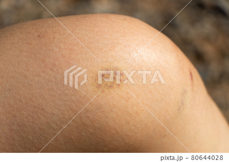 Background of bruised wound on wound woman at knee skin 80644028