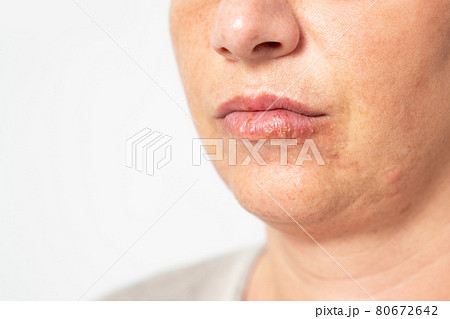 Young woman suffering from herpes on her lips. Concept skin problem, allergy and dermatology. Young woman suffering from herpes on her lips. Concept skin problem, allergy and dermatology. 80672642