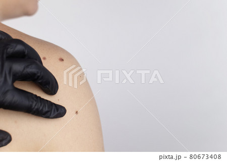 A man at a dermatologist appointment shows his birthmarks, moles and nevi. The doctor examines the patient with a dermatoscope. Benign and malignant birthmarks. Skin abnormalities care concept A man at a dermatologist appointment shows his birthmarks, moles and nevi. The doctor examines the patient with a dermatoscope. Benign and malignant birthmarks. Skin abnormalities care concept 80673408