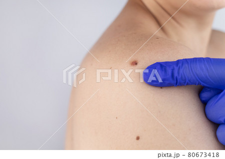 A man at a dermatologist appointment shows his birthmarks, moles and nevi. The doctor examines the patient with a dermatoscope. Benign and malignant birthmarks. Skin abnormalities care concept A man at a dermatologist appointment shows his birthmarks, moles and nevi. The doctor examines the patient with a dermatoscope. Benign and malignant birthmarks. Skin abnormalities care concept 80673418