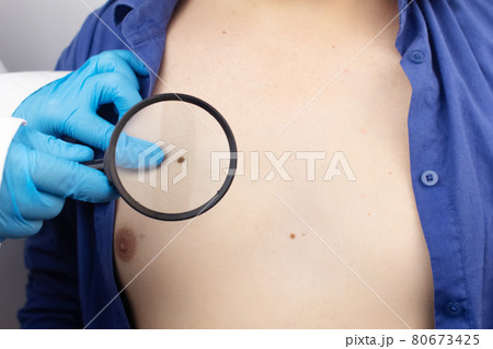 A man at a dermatologist appointment shows his birthmarks, moles and nevi. The doctor examines the patient with a dermatoscope. Benign and malignant birthmarks. Skin abnormalities care concept A man at a dermatologist appointment shows his birthmarks, moles and nevi. The doctor examines the patient with a dermatoscope. Benign and malignant birthmarks. Skin abnormalities care concept 80673425