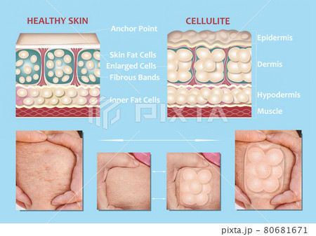 forming of underskin cellulite illustration 80681671