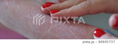 Sunburn cream is applied to the child red hand Sunburn cream is applied to the child red hand 80695737