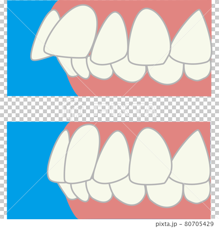 Twisting protruding side before and after tooth treatment Twisting protruding side before and after tooth treatment 80705429
