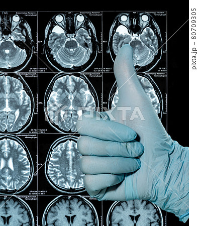 MRI Scan image of a human brain showing all main multiple sclerosis hand in glove thumbs up 80709305
