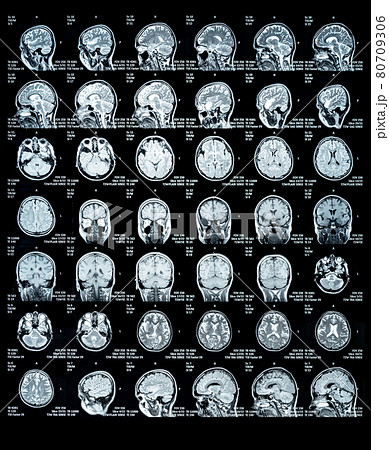 MRI Scan of a human brain showing all main multiple sclerosis details 80709306