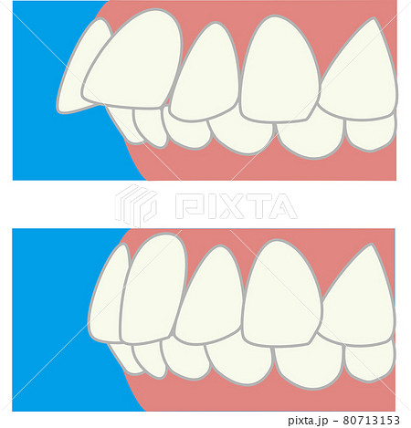 捻転突出側方のビフォーアフター　歯の治療　出っ歯 80713153