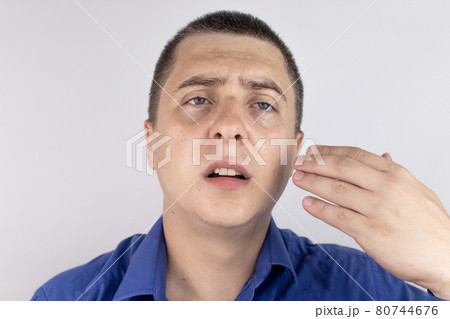 A man with sweating on his face is looking at the camera. Sweat gland problems. Hyperhidrosis, increased sweating, anhidrosis. The concept of treatment for violations of the mechanisms of secretion. 80744676