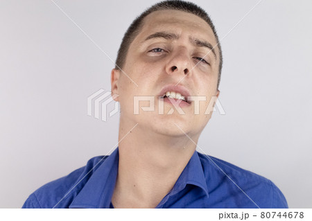 A man with sweating on his face is looking at the camera. Sweat gland problems. Hyperhidrosis, increased sweating, anhidrosis. The concept of treatment for violations of the mechanisms of secretion. 80744678