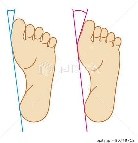 外反母趾の図解のイラスト 足の裏親指の変形関節リウマチのイラスト素材