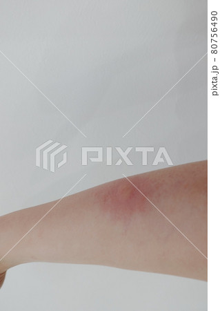 蚊に刺された 80756490