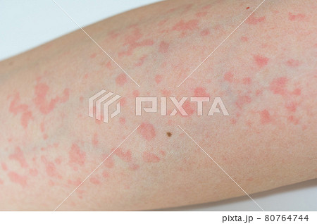 蕁麻疹の症状の写真素材