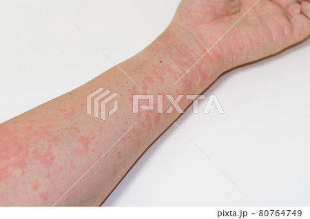 蕁麻疹の症状 蕁麻疹の症状 80764749