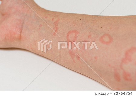 蕁麻疹の症状 80764754