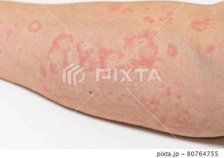 蕁麻疹の症状 80764755