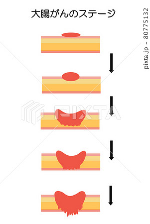 大腸がん ステージ進行のイラストのイラスト素材