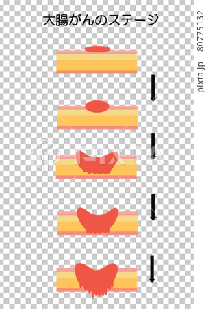 大腸がん ステージ進行のイラスト 大腸がん ステージ進行のイラスト 80775132