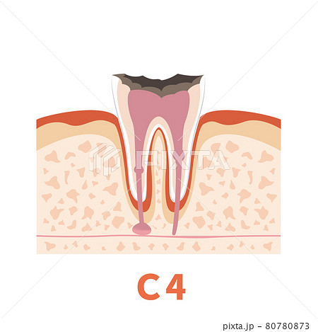 歯医者さんのWEB制作、グラフィック作品に使用できる歯科虫歯イラストc4 80780873