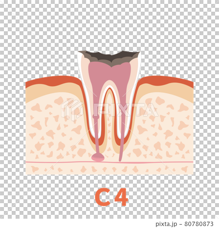 Dental caries illustration c4 that can be used for dentist's WEB production and graphic works 80780873