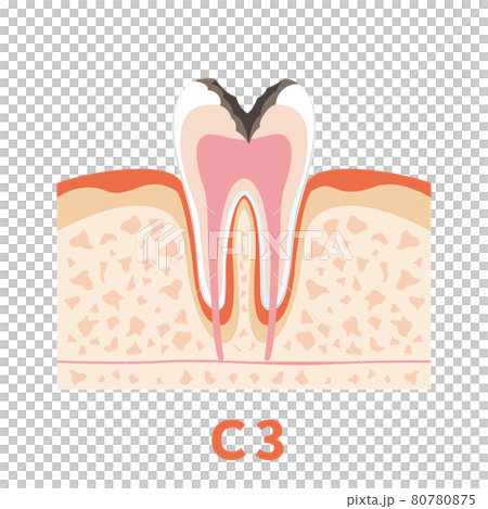 Dental caries illustration c3 that can be used for dentist's WEB production and graphic works 80780875