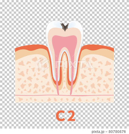 Dental caries illustration c2 that can be used for dentist's WEB production and graphic works 80780876