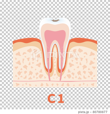Dental caries illustration c1 that can be used for dentist's WEB production and graphic works 80780877