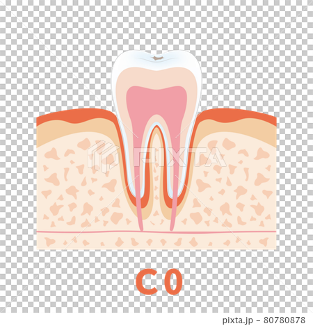 Dental caries illustration c0 that can be used for dentist's WEB production and graphic works 80780878