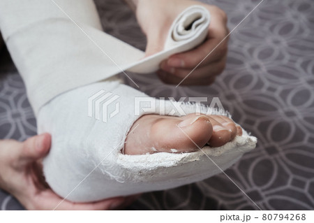 Applying an elastic bandage to a broken leg The leg is in a plaster cast. Home rehabilitation after a broken leg. High quality photo 80794268