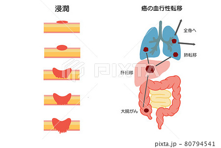 大腸がん 進行と転移の解説イラストのイラスト素材