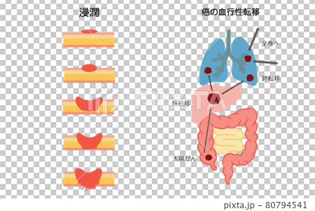 大腸がん　進行と転移の解説イラスト 80794541