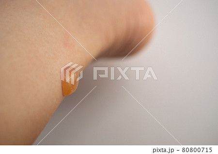 足に発症した水疱 80800715