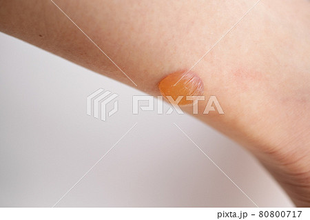 足に発症した水疱 80800717
