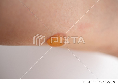 足に発症した水疱 80800719