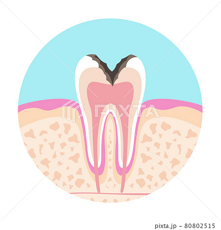 歯医者さんのイラスト歯科むし歯の絵 歯医者さんのイラスト歯科むし歯の絵 80802515