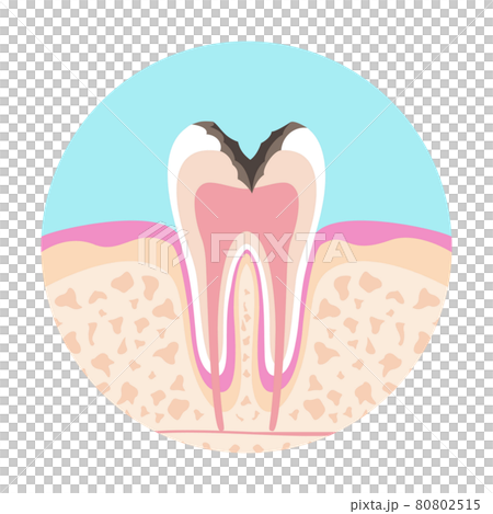歯医者さんのイラスト歯科むし歯の絵 歯医者さんのイラスト歯科むし歯の絵 80802515