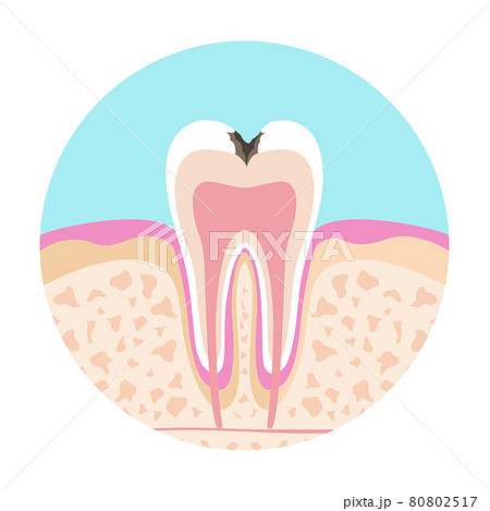 歯医者さんのイラスト歯科むし歯の絵 80802517