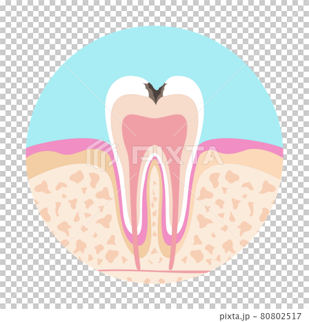 歯医者さんのイラスト歯科むし歯の絵 80802517