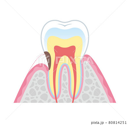 根面う蝕　イラスト図解 80814251