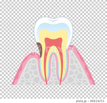根面う蝕　イラスト図解 80814251