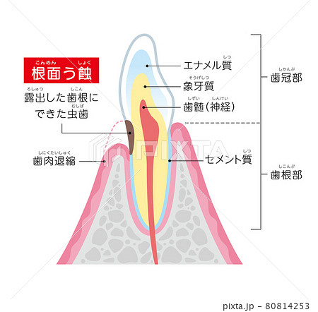 根面う蝕 イラスト図解のイラスト素材 [80814253] - PIXTA