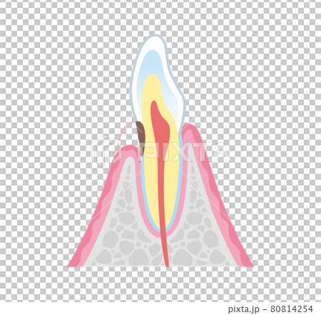 Root caries illustration illustration 80814254